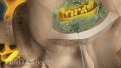 Epidural steroid injection injected into the nerve root