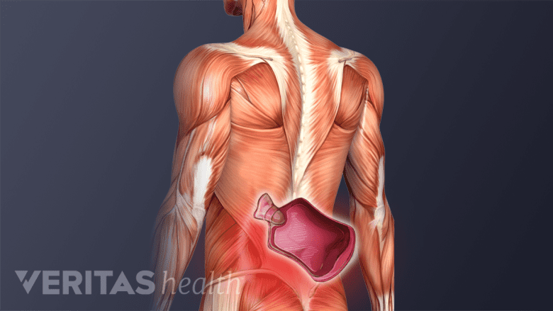 Illustration showing posterior view of torso and a heat pack icon in the lower back.