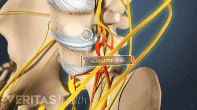 Medical illustration of a herniated disc