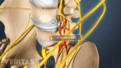 Anterior view of pelvis labeling a lumbar herniated disc