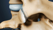 Spine arthritis in the facet joints of two vertebra.