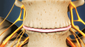 Focused on bone spurs of osteophytes on two vertebra.