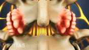 Posterior view of lumbar spine showing bones spurs in the facet joints