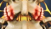 Posterior view of lumbar spine showing bones spurs in the facet joints