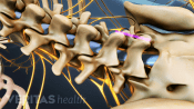 Lumbar spine showing incision point of fusion.