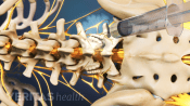 Anesthetic injection being injected into the lumbar spine.