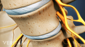 Lumbar disc between L4 and L5.