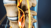Profile view of lumbar spine with spinal stenosis.