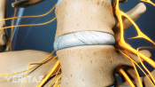 Lumbar disc between L4 and L5.
