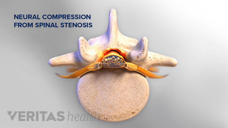 Illustration showing a lumbar spine with spinal stenosis.