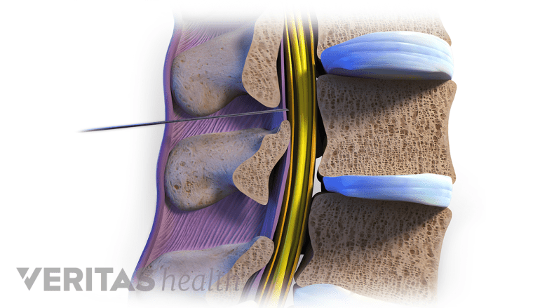 Needle in the epidural space of the lumbar spine.