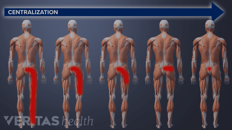 Sciatica and back pain centralization through McKenzie method back exercises.