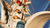 Posterior view of pelvis showing injection of medial branch blocks.