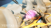 Medical illustration showing a medial branch nerve block injection