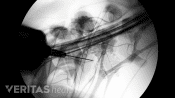 Medial nerve block with xray guidance
