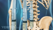 Three syringes used as a medial nerve block