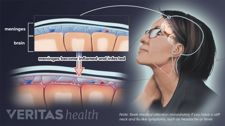 Woman with meningitis.