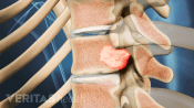 Profile view of metastatic tumor in a vertebra.
