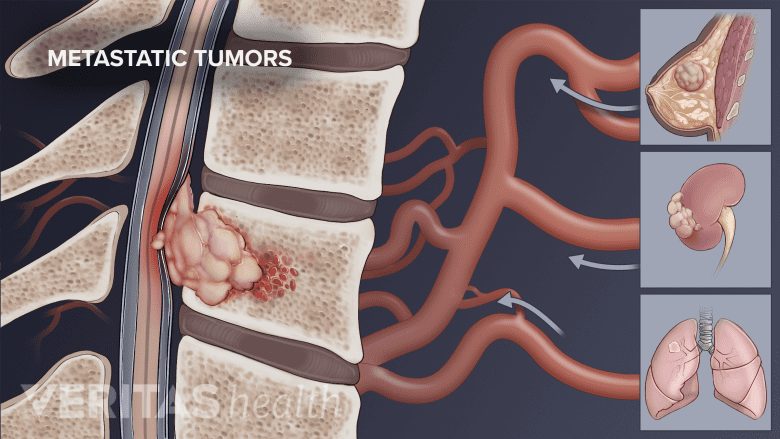 Un tumor metastásico en la columna vertebral.