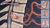 Diagram showing a metastatic tumor in the spinal column