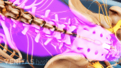 Dolor lumbar que se irradia por toda la columna lumbar.