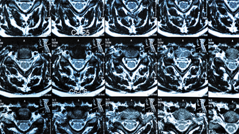 MRI Scan of Cervical Spine
