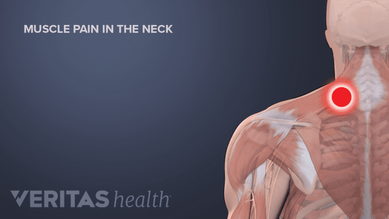 Illustration showing trigger points in the neck.