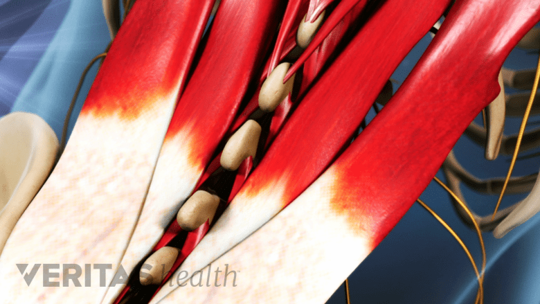 An illustration showing adult spine with muscles highlighted in red.
