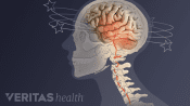 Illustration of a problem in the neck leading to dizziness