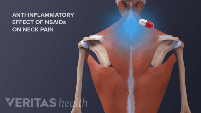 Illustration showing posterior view of the upper body with neck area highlighted in blue with a pill.