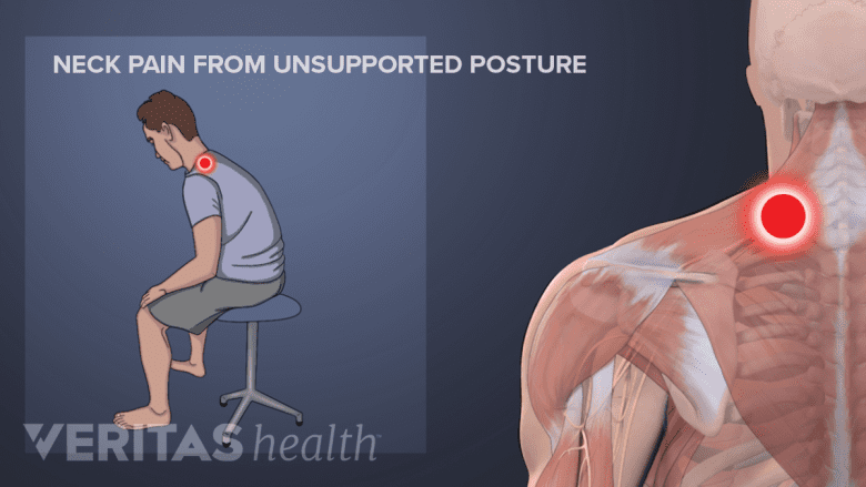 Illustration showing bad posture and pain in the neck area highlighted in red.