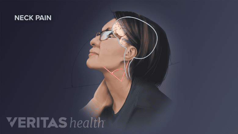 An Illustration of a woman with neck pain.