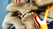Closeup view of bone spurs on facet joints, a common cause of stenosis