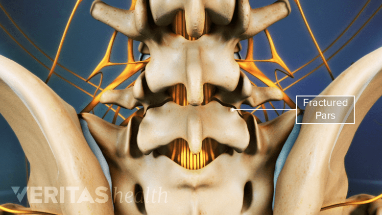 pars fracture in the lower back