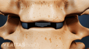 Anterior view of artificial disc inserted between two cervical vertebrae