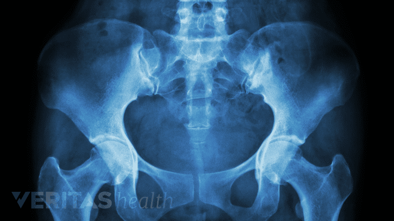 X-ray of pelvis.