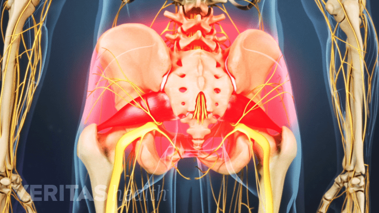 An illustration showing highlighted area of pain in the buttock.