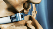 A cage is an implant that provides more normal spacing between vertebrae.
