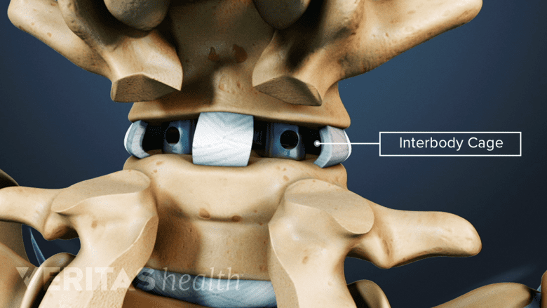 Some interbody fusion procedures use cages for bone grafts.