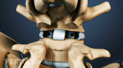 Posterior view of lumbar spine with PLIF implants.