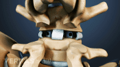 An interbody cage between two vertebrae.
