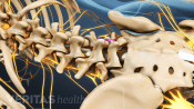 Posterior view of the lumbar spine for location of fusion.