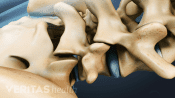 Artificial disc in the lumbar spine