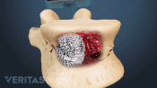 Pmma injection during kyphoplasty procedure