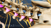 Posterior view of the lumbar spine showing location of bone graft.