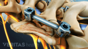 Posterior view of spine showing spinal fusion instrumentation.