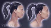 Illustration of the effect of forward head posture on the neck muscles