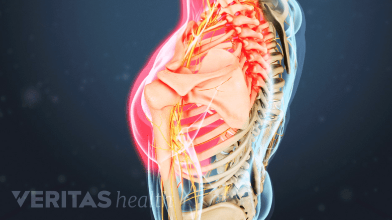 Medical illustration showing neck and shoulder pain.