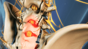 Medical illustration of the lumbar spine showing bone spurs on the facet joints