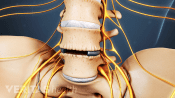 Anterior view of lumbar spine with disc material removed.